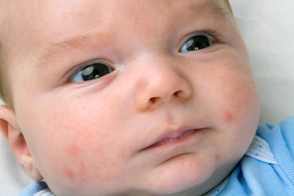 Baby Acne: Something You Drink Can Help Keep This Newborn Skin Condition Away!