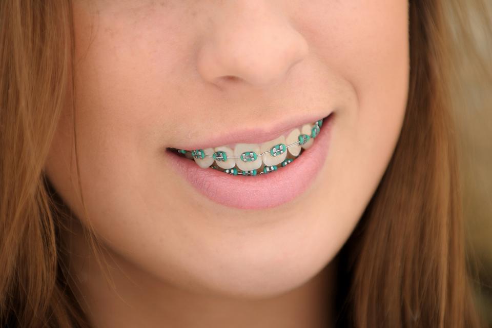 How much do braces cost?